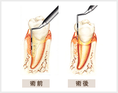 中等度の歯周病に対する歯周組織再生療法